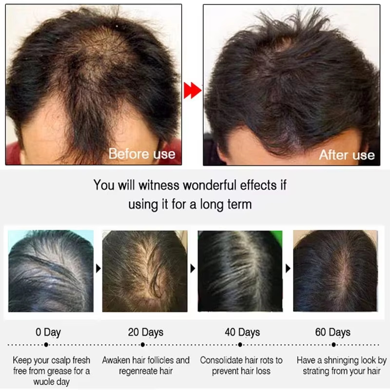 สเปรย์เร่งผมยาวขึ้นอย่างรวดเร็ - Hair Care For Men บทวิจารณ์และราคา